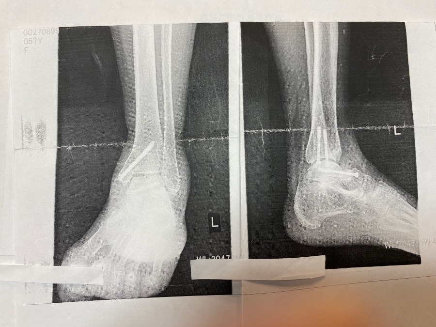 足骨折から8か月