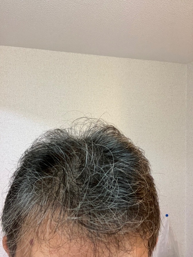 ヘアフィラー６日目