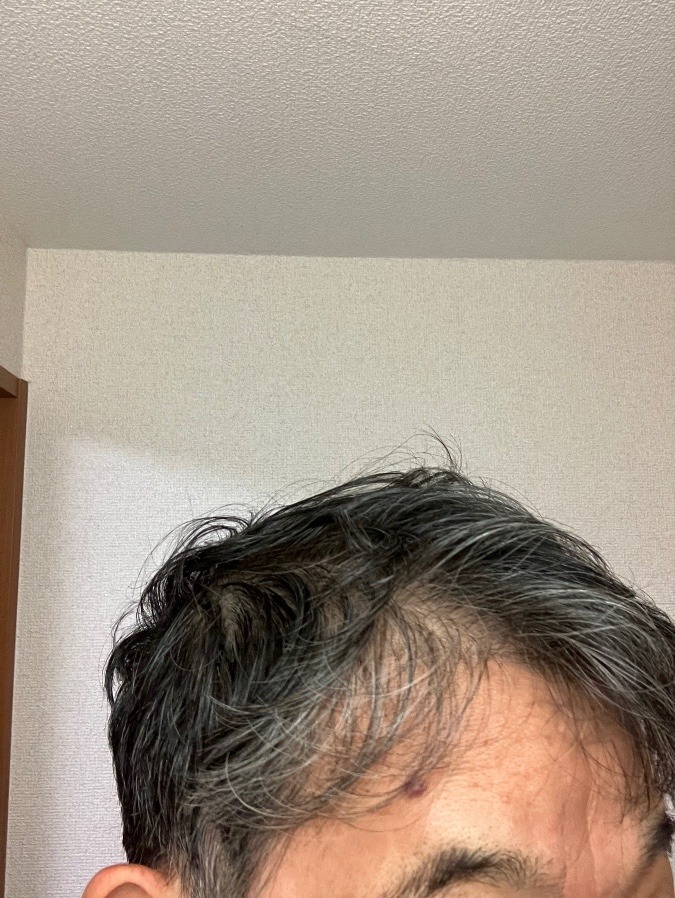 ヘアフィラー１０日目