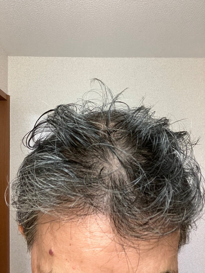 ヘアフィラー８日目