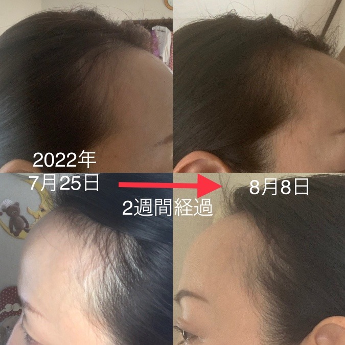 ヘアフィラー