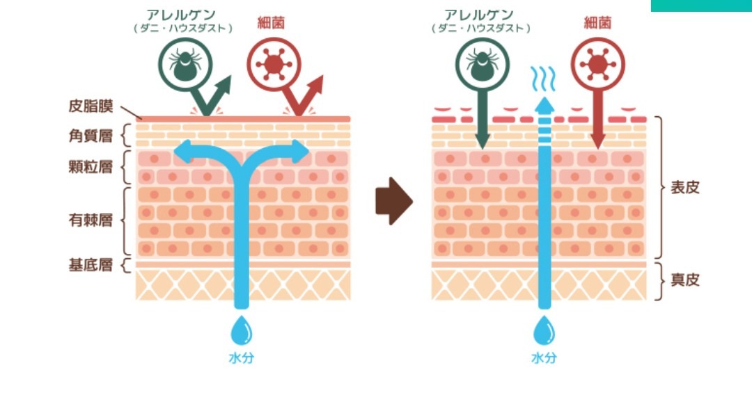 アトピー性皮膚炎だった　私が！えッ