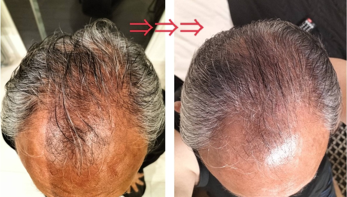 ヘアフィラー3週間で！②