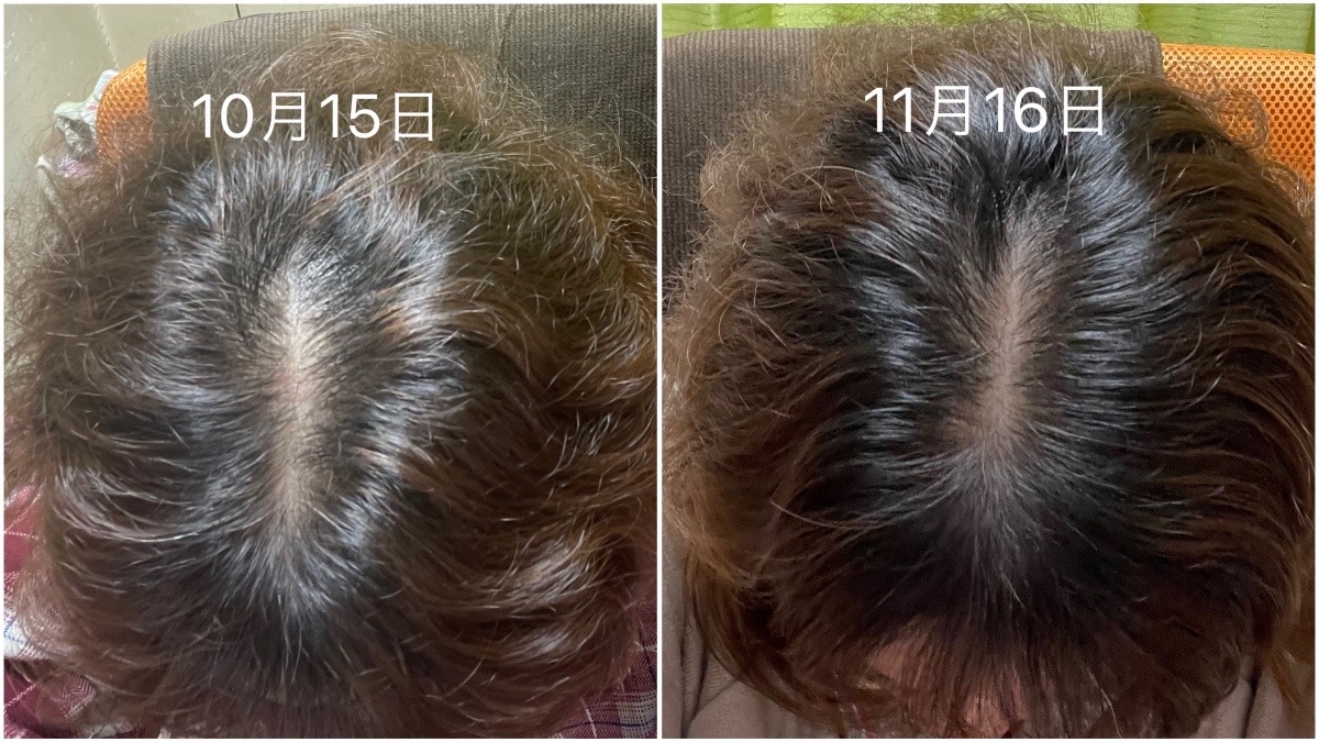 ヘアフィラー使用経過