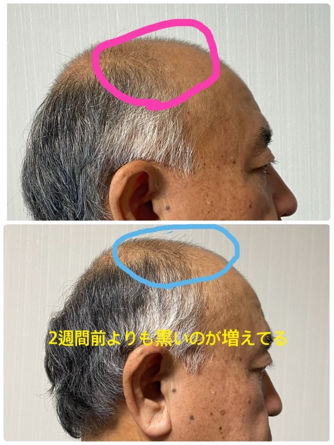 また黒いのが増えてる、すごい効果だヘアフィラー！